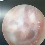 PHẪU THUẬT VÁ NHĨ NỘI SOI